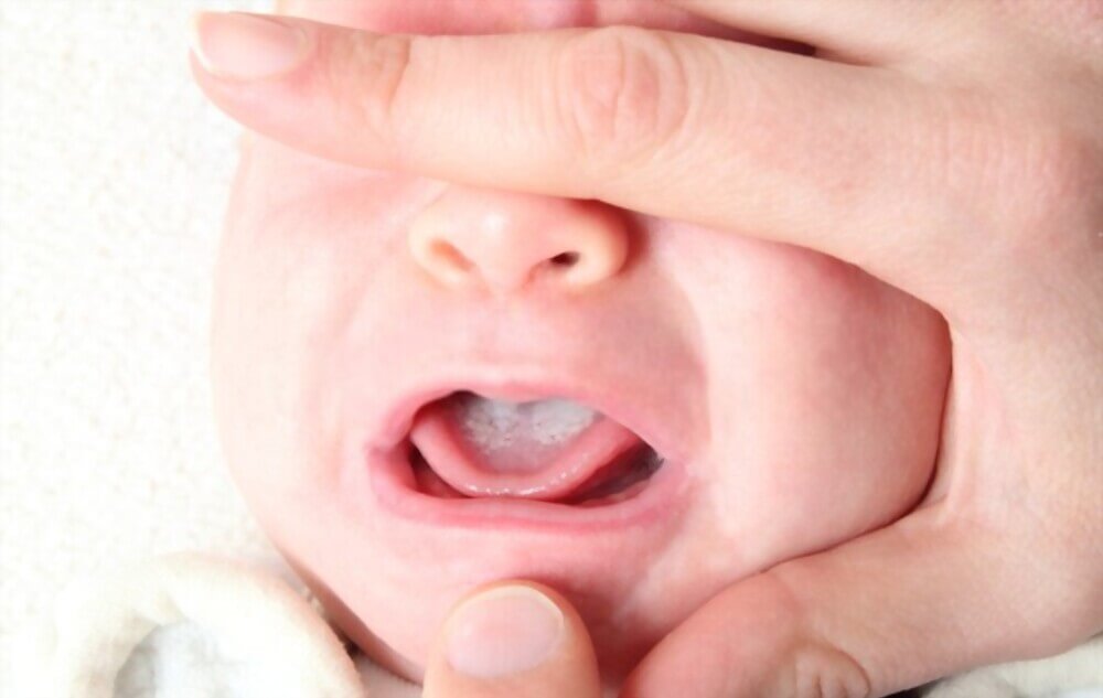 Oral Thrush in Babies, Causes, Symptoms, and Treatments