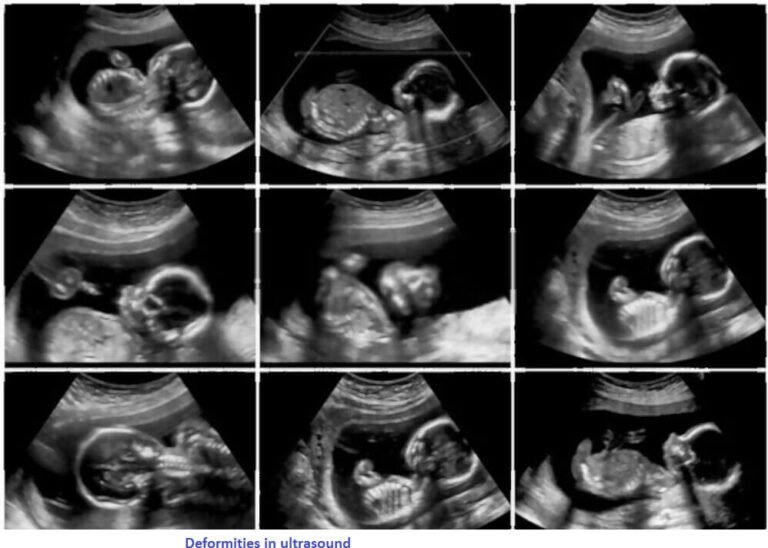 20 Week Anatomy Scan(Ultrasound Scan)? Look After Babies