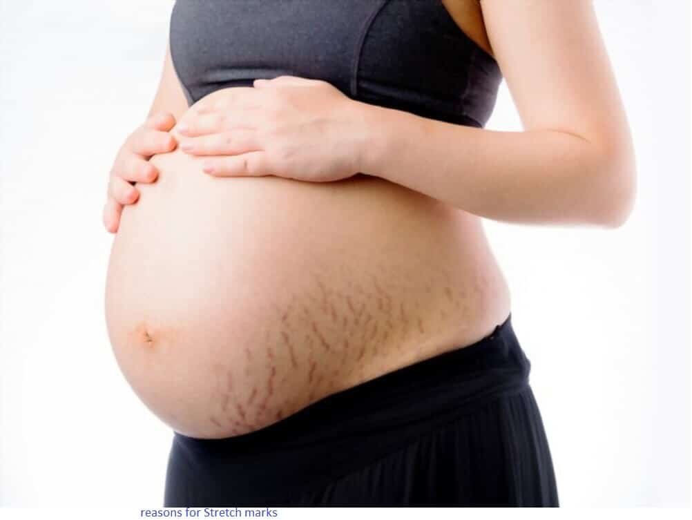 Are Stretch Marks Genetic