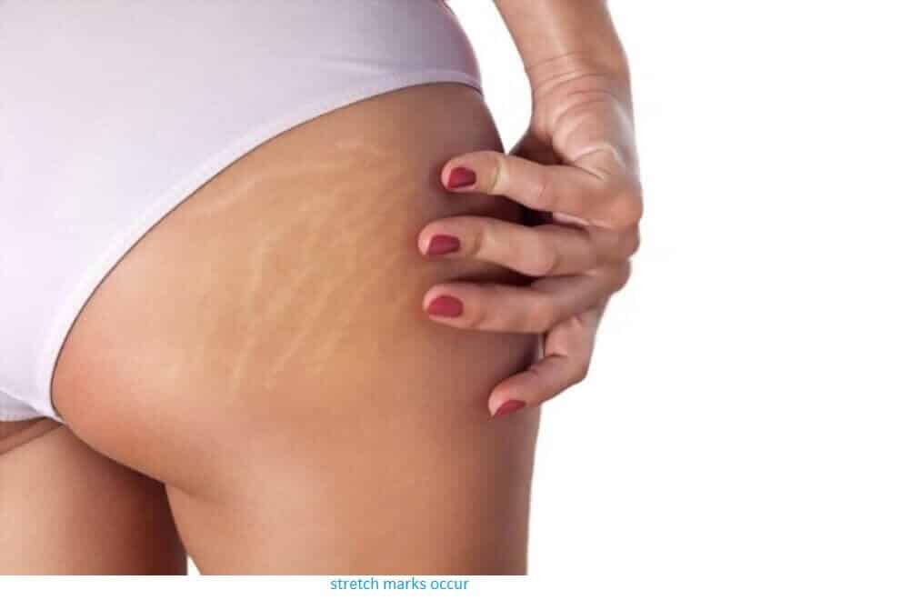 Are Stretch Marks Genetic
