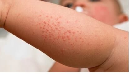Baby Heat Rash: How To Treat and Prevent It