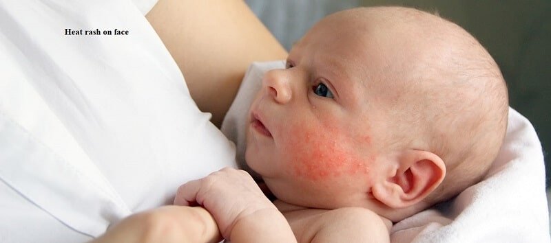 Baby Heat Rash: How To Treat and Prevent It
