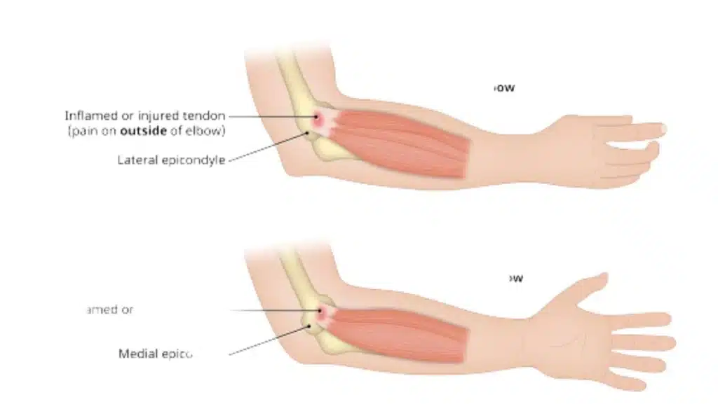 Surgery Free Tennis Elbow Pain Relief - Tips And Strategies